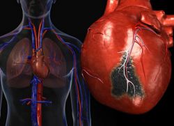 Revmatizem simptomov srca