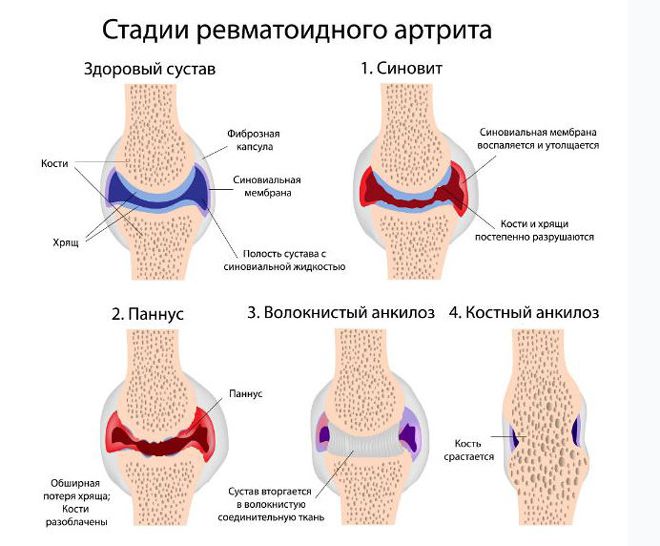 стадии ревматоидного артрита