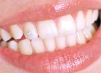 rhinestones na zubima 2