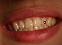 strukovi na zubima 6