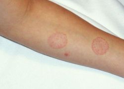 Znaky kožního onemocnění u osoby