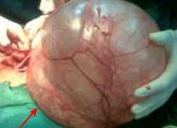 serous papillary ovarian cystadenoma