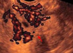 rak materničnih znakov ultrazvoka