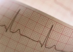zatokowa arytmia na EKG