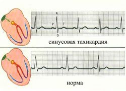 Što je opasna sinusna tahikardija srca?