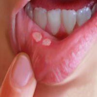 vzrok za razjede v ustih