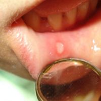 bolest v ústech, jak se léčit