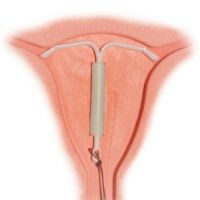 Mirena a endometrióza