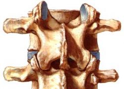 lumbální spondyloarthrosis deformans