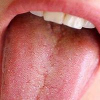 bílé skvrny na jazyku