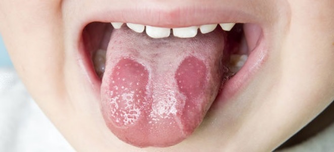 objawy zapalenia jamy ustnej u dzieci