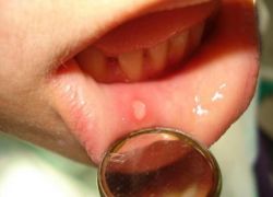 stomatitis na ustnici otroka