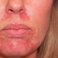 liječenje streptokoknim infekcijama kože