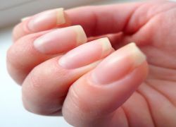 Podłużne paski na paznokciach powodują