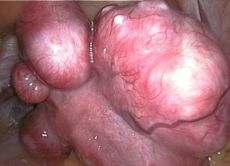 léčba submukózních fibroidů