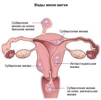 submukozni mitomi uterusa