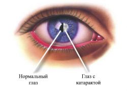 Příznaky očního kataraktu
