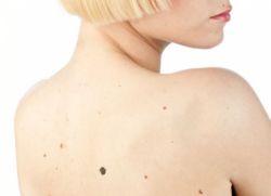 známky kožního melanomu