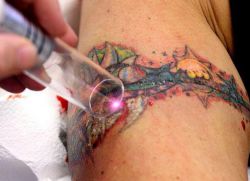 tetování odstraňovač