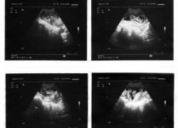 gestacijsko obdobje po ultrazvoku