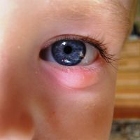 третман јечма у очима детета