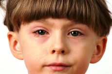 него испирање очију са коњунктивитисом код деце