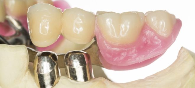 Видове зъбни протези