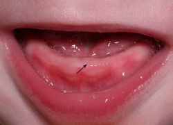Как се отрязват първите зъби