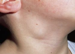 запаљење лимфних чворова у врату детета