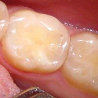 Временният пълнеж боли зъба
