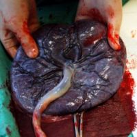 placenta je deblja od normalne