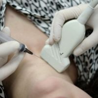 Как се извършва биопсията на щитовидната жлеза?