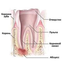Абцесс оф симптоми зуба