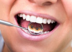 подреждане на зъбите със скоби