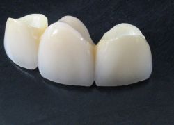 kovinski keramični zobni mostički