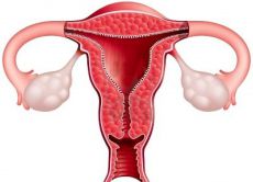 endometriální léčba hyperplázie po kyretáži