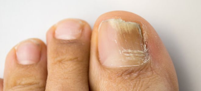 Грибок ногтя симптомы нога