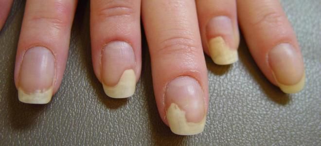 Грибок ногтя симптомы рука
