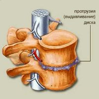 izboklina ledvene hrbtenice
