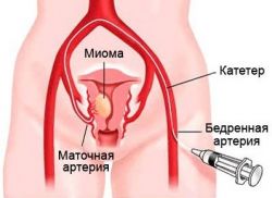 neoperační léčba děložního myomu