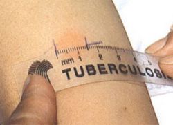што је доказано правим окретањем теста туберкулина