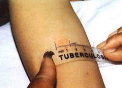 test tuberkulinowy