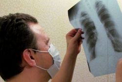 tuberkulóza páteřních kostí