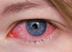 oční tuberkulózou