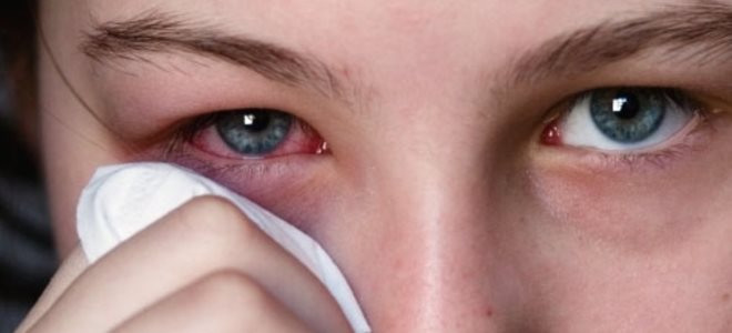 tuberkuloza oka prvi simptomi