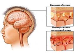 Objawy gruźliczych objawów opon mózgowych