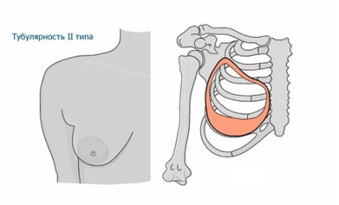 cylindryczna klatka piersiowa1