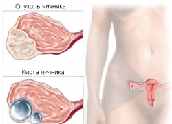 ovariálního nádoru u žen