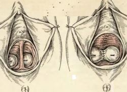 anomalija dvije vagine
