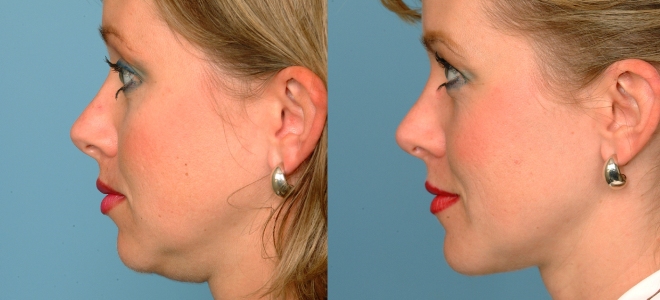ultrazvočna liposukcija pred in po fotografijah